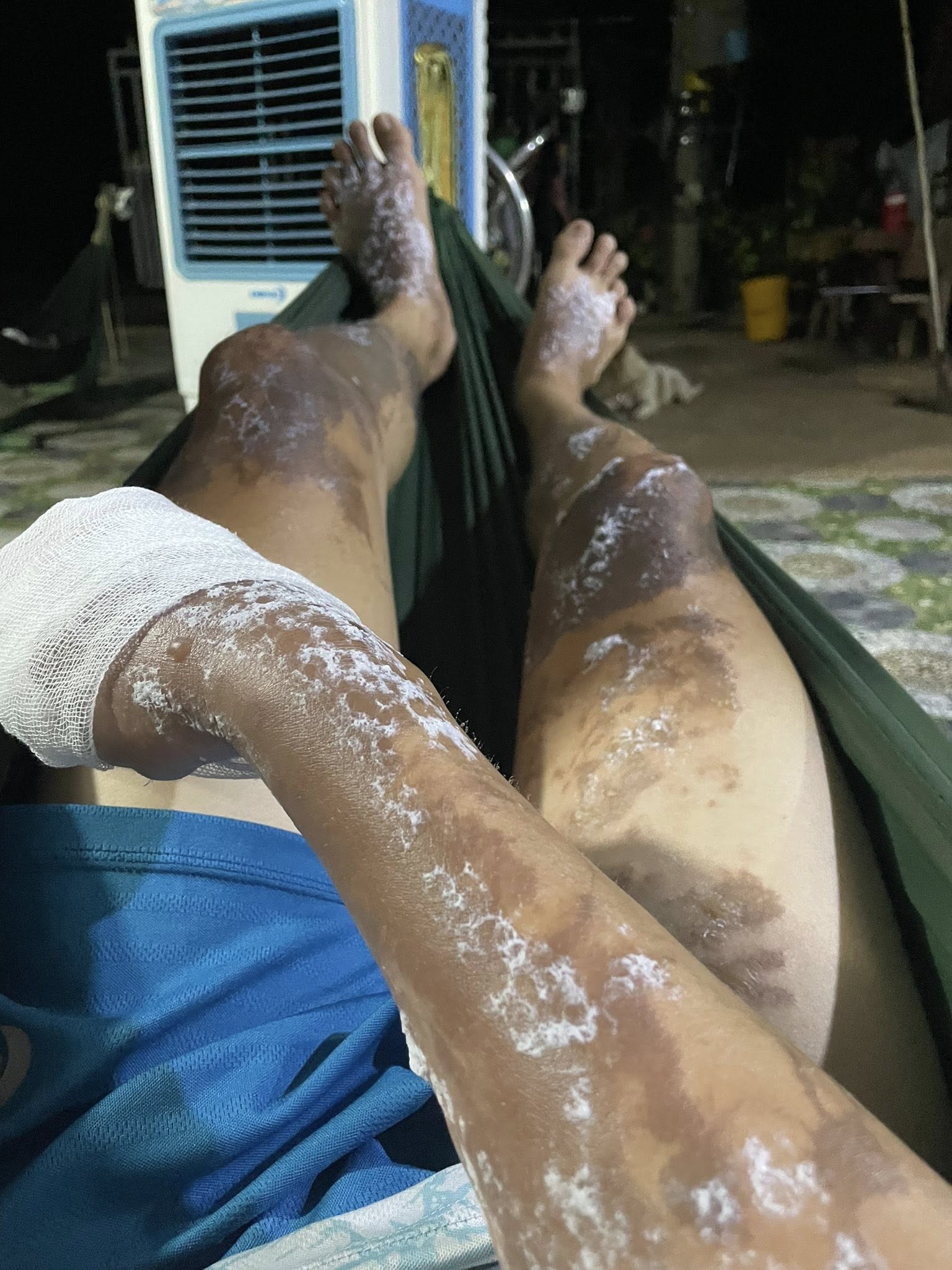 Bỏng nặng do hoá chất thông cống